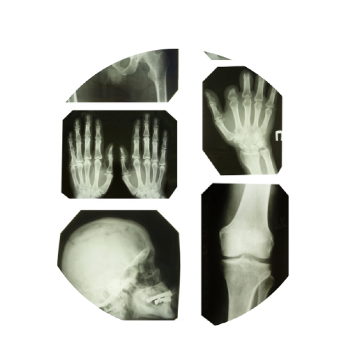 xray of broken wrist 