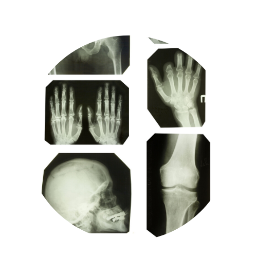 xray of broken wrist 